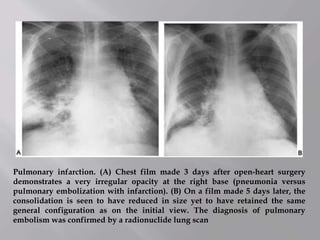 Pulmonary infarction. (A) Chest film made 3 days after open-heart surgery
demonstrates a very irregular opacity at the right base (pneumonia versus
pulmonary embolization with infarction). (B) On a film made 5 days later, the
consolidation is seen to have reduced in size yet to have retained the same
general configuration as on the initial view. The diagnosis of pulmonary
embolism was confirmed by a radionuclide lung scan
 