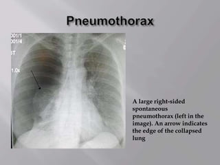 A large right-sided
spontaneous
pneumothorax (left in the
image). An arrow indicates
the edge of the collapsed
lung
 