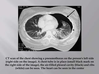 CT scan of the chest showing a pneumothorax on the person's left side
(right side on the image). A chest tube is in place (small black mark on
the right side of the image), the air-filled pleural cavity (black) and ribs
(white) can be seen. The heart can be seen in the center
 