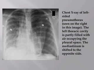 Chest X-ray of left-
sided
pneumothorax
(seen on the right
in this image). The
left thoracic cavity
is partly filled with
air occupying the
pleural space. The
mediastinum is
shifted to the
opposite side.
 