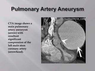 CTA image shows a
main pulmonary
artery aneurysm
(arrow) with
resultant
significant
compression of the
left main stem
coronary artery
(arrowhead).
 