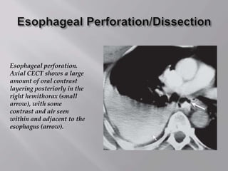 Esophageal perforation.
Axial CECT shows a large
amount of oral contrast
layering posteriorly in the
right hemithorax (small
arrow), with some
contrast and air seen
within and adjacent to the
esophagus (arrow).
 