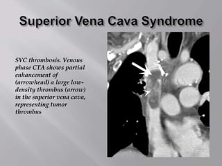 SVC thrombosis. Venous
phase CTA shows partial
enhancement of
(arrowhead) a large low-
density thrombus (arrow)
in the superior vena cava,
representing tumor
thrombus
 