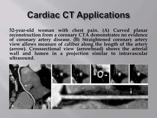 52-year-old woman with chest pain. (A) Curved planar
reconstruction from a coronary CTA demonstrates no evidence
of coronary artery disease. (B) Straightened coronary artery
view allows measure of caliber along the length of the artery
(arrow). Crosssectional view (arrowhead) shows the arterial
wall and lumen in a projection similar to intravascular
ultrasound.
 