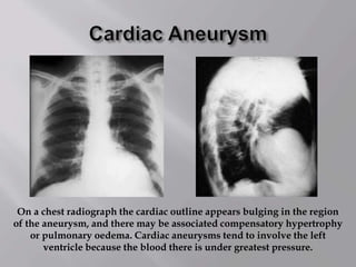 On a chest radiograph the cardiac outline appears bulging in the region
of the aneurysm, and there may be associated compensatory hypertrophy
or pulmonary oedema. Cardiac aneurysms tend to involve the left
ventricle because the blood there is under greatest pressure.
 