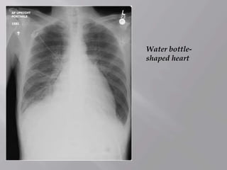 Water bottle-
shaped heart
 