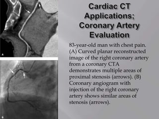 83-year-old man with chest pain.
(A) Curved planar reconstructed
image of the right coronary artery
from a coronary CTA
demonstrates multiple areas of
proximal stenosis (arrows). (B)
Coronary angiogram with
injection of the right coronary
artery shows similar areas of
stenosis (arrows).
 