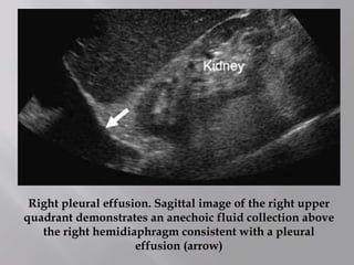 Right pleural effusion. Sagittal image of the right upper
quadrant demonstrates an anechoic fluid collection above
the right hemidiaphragm consistent with a pleural
effusion (arrow)
 