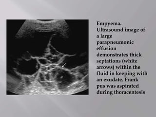 Empyema.
Ultrasound image of
a large
parapneumonic
effusion
demonstrates thick
septations (white
arrows) within the
fluid in keeping with
an exudate. Frank
pus was aspirated
during thoracentesis
 