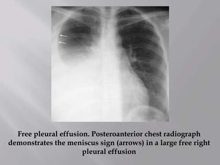 Free pleural effusion. Posteroanterior chest radiograph
demonstrates the meniscus sign (arrows) in a large free right
pleural effusion
 