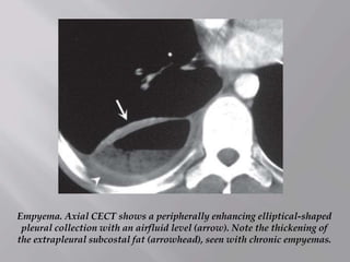 Empyema. Axial CECT shows a peripherally enhancing elliptical-shaped
pleural collection with an airfluid level (arrow). Note the thickening of
the extrapleural subcostal fat (arrowhead), seen with chronic empyemas.
 