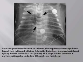 Loculated pneumomediastinum in an infant with respiratory distress syndrome.
Frontal chest radiograph obtained 5 days after birth shows a rounded radiolucent
opacity over the mediastinal area (arrows). This image was not present in a
previous radiographic study done 48 hours before (not shown)
 