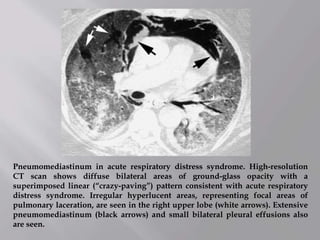 Pneumomediastinum in acute respiratory distress syndrome. High-resolution
CT scan shows diffuse bilateral areas of ground-glass opacity with a
superimposed linear (“crazy-paving”) pattern consistent with acute respiratory
distress syndrome. Irregular hyperlucent areas, representing focal areas of
pulmonary laceration, are seen in the right upper lobe (white arrows). Extensive
pneumomediastinum (black arrows) and small bilateral pleural effusions also
are seen.
 