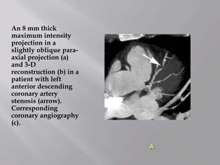 A
An 8 mm thick
maximum intensity
projection in a
slightly oblique para-
axial projection (a)
and 3-D
reconstruction (b) in a
patient with left
anterior descending
coronary artery
stenosis (arrow).
Corresponding
coronary angiography
(c).
 
