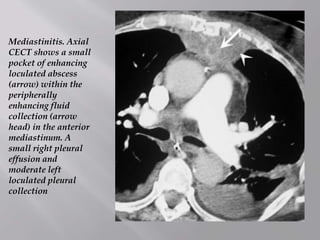 Mediastinitis. Axial
CECT shows a small
pocket of enhancing
loculated abscess
(arrow) within the
peripherally
enhancing fluid
collection (arrow
head) in the anterior
mediastinum. A
small right pleural
effusion and
moderate left
loculated pleural
collection
 