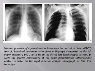 Normal position of a percutaneous intravascular central catheter (PICC)
line. A. Standard posteroanterior chest radiograph demonstrates the left
upper extremity PICC with tip in the distal left brachiocephalic vein. B.
Note the greater conspicuity of the same percutaneous intravascular
central catheter on the right anterior oblique radiograph at low kVp
technique
 