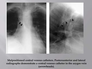 Malpositioned central venous catheters. Posteroanterior and lateral
radiographs demonstrate a central venous catheter in the azygos vein
(arrowheads).
 