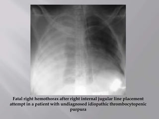 Fatal right hemothorax after right internal jugular line placement
attempt in a patient with undiagnosed idiopathic thrombocytopenic
purpura
 