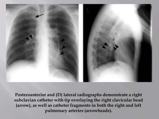 Posteroanterior and (D) lateral radiographs demonstrate a right
subclavian catheter with tip overlaying the right clavicular head
(arrow), as well as catheter fragments in both the right and left
pulmonary arteries (arrowheads).
 