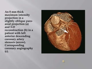 B
An 8 mm thick
maximum intensity
projection in a
slightly oblique para-
axial projection (a)
and 3-D
reconstruction (b) in a
patient with left
anterior descending
coronary artery
stenosis (arrow).
Corresponding
coronary angiography
(c).
 