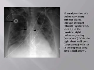 Normal position of a
pulmonary artery
catheter placed
through the right
internal jugular vein,
with tip in the
proximal right
pulmonary artery
(arrowhead). Note the
right chest wall port
(large arrow) with tip
in the superior vena
cava (small arrow).
 