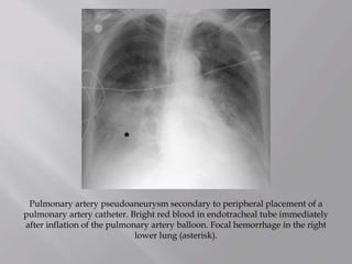 Pulmonary artery pseudoaneurysm secondary to peripheral placement of a
pulmonary artery catheter. Bright red blood in endotracheal tube immediately
after inflation of the pulmonary artery balloon. Focal hemorrhage in the right
lower lung (asterisk).
 