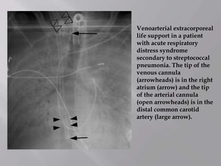 Venoarterial extracorporeal
life support in a patient
with acute respiratory
distress syndrome
secondary to streptococcal
pneumonia. The tip of the
venous cannula
(arrowheads) is in the right
atrium (arrow) and the tip
of the arterial cannula
(open arrowheads) is in the
distal common carotid
artery (large arrow).
 