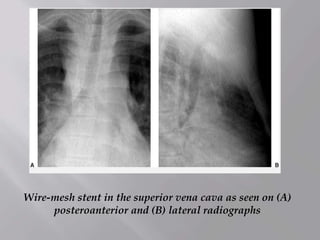 Wire-mesh stent in the superior vena cava as seen on (A)
posteroanterior and (B) lateral radiographs
 