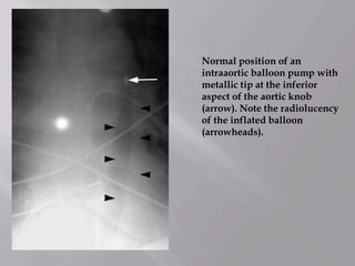 Normal position of an
intraaortic balloon pump with
metallic tip at the inferior
aspect of the aortic knob
(arrow). Note the radiolucency
of the inflated balloon
(arrowheads).
 