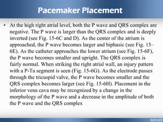 Pacemaker Placement
• At the high right atrial level, both the P wave and QRS complex are
negative. The P wave is larger than the QRS complex and is deeply
inverted (see Fig. 15-6C and D). As the center of the atrium is
approached, the P wave becomes larger and biphasic (see Fig. 15–
6E). As the catheter approaches the lower atrium (see Fig. 15-6F),
the P wave becomes smaller and upright. The QRS complex is
fairly normal. When striking the right atrial wall, an injury pattern
with a P-Ta segment is seen (Fig. 15-6G). As the electrode passes
through the tricuspid valve, the P wave becomes smaller and the
QRS complex becomes larger (see Fig. 15-6H). Placement in the
inferior vena cava may be recognized by a change in the
morphology of the P wave and a decrease in the amplitude of both
the P wave and the QRS complex
 