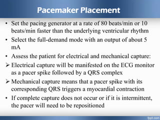 Pacemaker Placement
• Set the pacing generator at a rate of 80 beats/min or 10
beats/min faster than the underlying ventricular rhythm
• Select the full-demand mode with an output of about 5
mA
• Assess the patient for electrical and mechanical capture:
 Electrical capture will be manifested on the ECG monitor
as a pacer spike followed by a QRS complex
 Mechanical capture means that a pacer spike with its
corresponding QRS triggers a myocardial contraction
• If complete capture does not occur or if it is intermittent,
the pacer will need to be repositioned
 