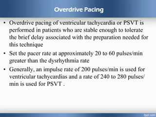 Overdrive Pacing
• Overdrive pacing of ventricular tachycardia or PSVT is
performed in patients who are stable enough to tolerate
the brief delay associated with the preparation needed for
this technique
• Set the pacer rate at approximately 20 to 60 pulses/min
greater than the dysrhythmia rate
• Generally, an impulse rate of 200 pulses/min is used for
ventricular tachycardias and a rate of 240 to 280 pulses/
min is used for PSVT .
 
