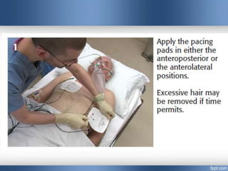 Emergency cardiac pacing