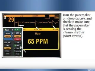 Emergency cardiac pacing