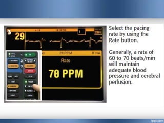 Emergency cardiac pacing