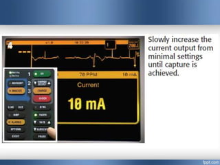 Emergency cardiac pacing