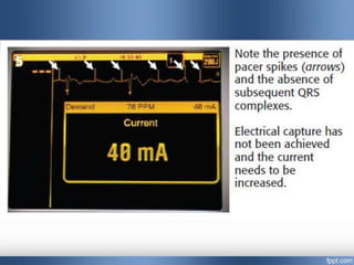 Emergency cardiac pacing