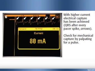 Emergency cardiac pacing