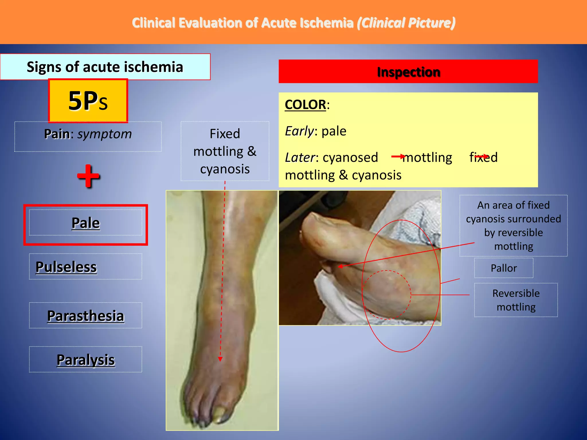 Acute Limb Ischemia - Emergency Case presentation | PPTX