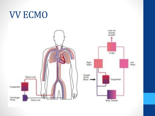 ECMO for Cardiac Arrest | PPTX