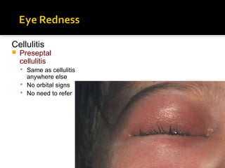 Cellulitis
 Preseptal
cellulitis
 Same as cellulitis
anywhere else
 No orbital signs
 No need to refer
 