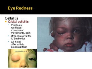 Cellulitis
 Orbital cellulitis
 Proptosis,
restricted
extraocular
movements, pain
 Urgent referral for
IV antibiotics
 CT helps
differentiate
preseptal form
 
