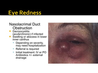 Nasolacrimal Duct
Obstruction
 Dacryocystitis
(acute/chronic) if infected
 Swelling or abscess in lower
inner canthus
 Depending on severity,
may need hospitalization
 Referral is required
 Initial treatment: IV or PO
Antibiotics +/- external
drainage
 