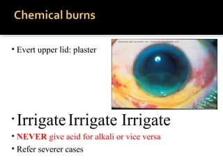 • Evert upper lid: plaster
• IrrigateIrrigate Irrigate
• NEVER give acid for alkali or vice versa
• Refer severer cases
 