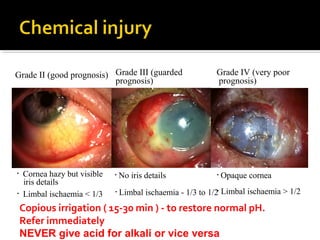 • Cornea hazy but visible
iris details
Grade II (good prognosis)
• Limbal ischaemia < 1/3
• No iris details
Grade III (guarded
prognosis)
• Limbal ischaemia - 1/3 to 1/2
• Opaque cornea
Grade IV (very poor
prognosis)
• Limbal ischaemia > 1/2
Copious irrigation ( 15-30 min ) - to restore normal pH.
Refer immediately
NEVER give acid for alkali or vice versa
 