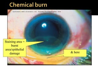 Staining area =
burnt
area/epithelial
damage & here
 