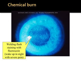 Welding flash
staining with
fluorescein
(wake up in night
with severe pain)
 
