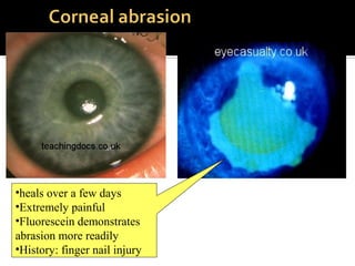 •heals over a few days
•Extremely painful
•Fluorescein demonstrates
abrasion more readily
•History: finger nail injury
 