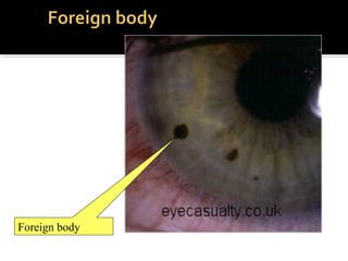 Foreign body
 