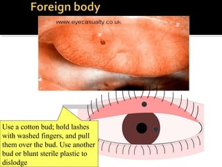 Use a cotton bud; hold lashes
with washed fingers, and pull
them over the bud. Use another
bud or blunt sterile plastic to
dislodge
 